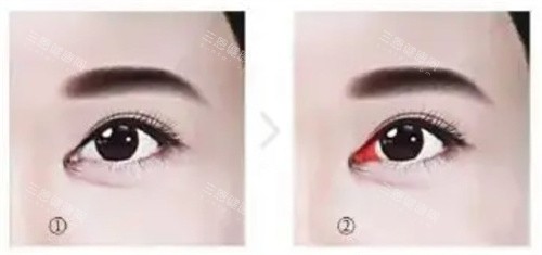 需要修复的内眼角