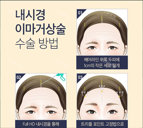 拉皮内窥镜去皱手术方法示例图 拉皮内窥镜去皱手术方法示例图