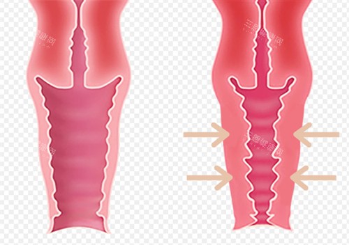 阴道紧缩术 阴道紧缩术