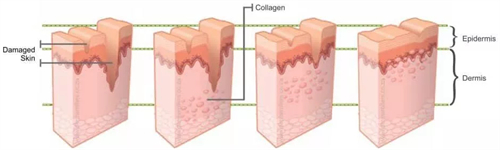 凹陷疤痕填充前后对比 凹陷疤痕填充前后对比