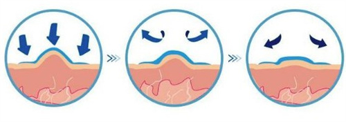 疤痕增生 疤痕增生