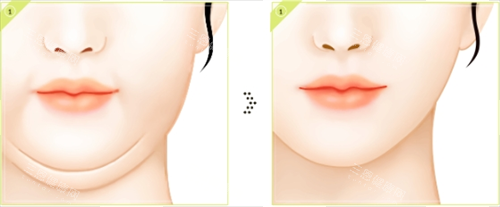 激光溶脂前后对比素材 激光溶脂前后对比素材