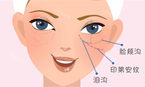 泪沟卡通图 泪沟卡通图