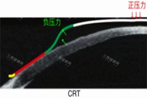 CRT角膜塑形镜力的示意图