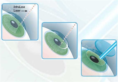近视手术过程图解