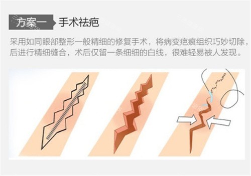西安西美整形外手术祛疤原理图