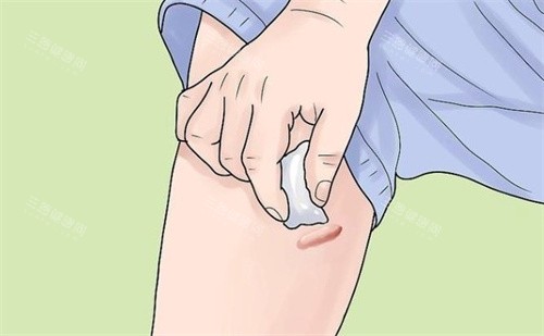 西安西美整形外疤痕疙瘩怎么护理