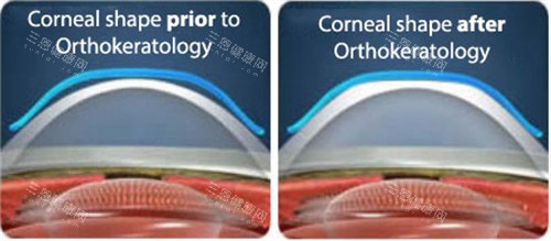角膜塑形镜眼表前后对比 角膜塑形镜眼表前后对比