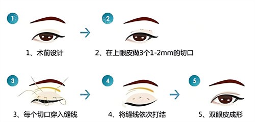 双眼皮三点术过程原理