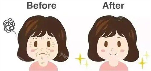 面部提升抗衰对比