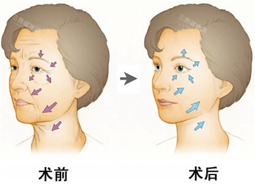 面部提升术前后对比