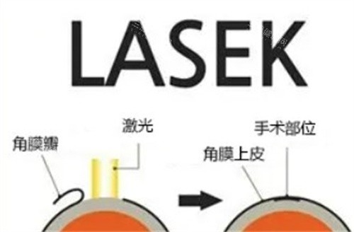 LASEK手术