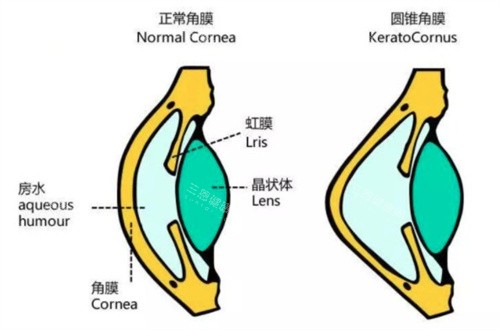 圆锥角膜和正常角膜动画