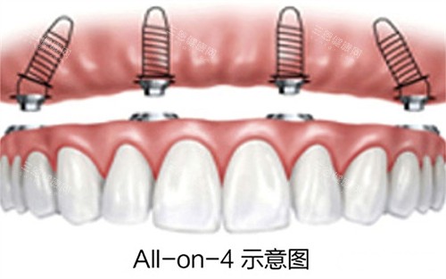 all-on-4半口种植牙示意图