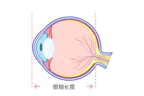 眼轴长度卡通图