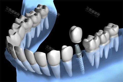 种植牙展示图