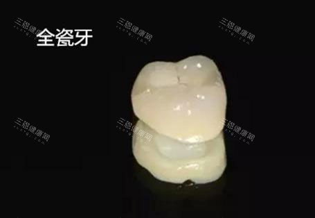 单颗全瓷牙冠