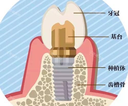 种植牙结构图