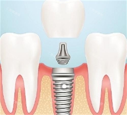 种植牙的组成部分