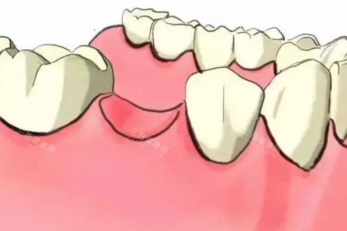 牙齿缺失模型图