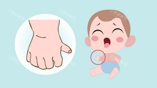 儿童手指畸形示意图