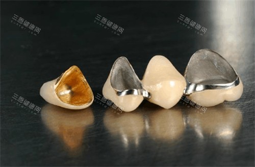 不同材质的烤瓷牙 不同材质的烤瓷牙