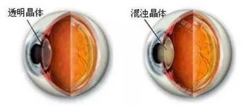 透明晶体和混浊晶体对比图 透明晶体和混浊晶体对比图