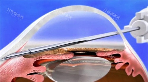 青光眼引流阀植入手术 青光眼引流阀植入手术