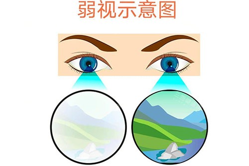 弱视示意图 弱视示意图