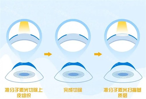 哈尔滨龙润眼科不同的近视手术 哈尔滨龙润眼科不同的近视手术