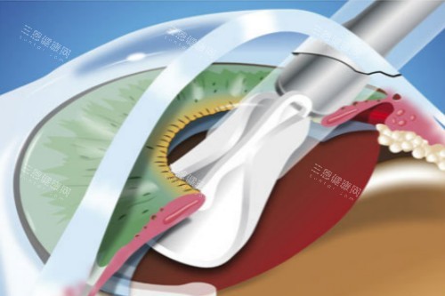 哈尔滨龙润眼科白内障超声乳化术 哈尔滨龙润眼科白内障超声乳化术