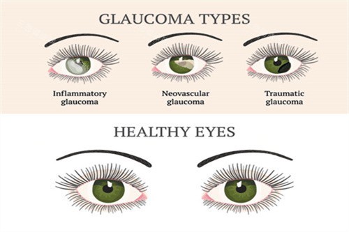 哈尔滨龙润眼科青光眼类型 哈尔滨龙润眼科青光眼类型