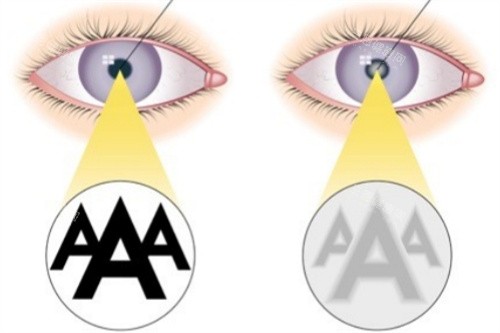 白内障成像 白内障成像