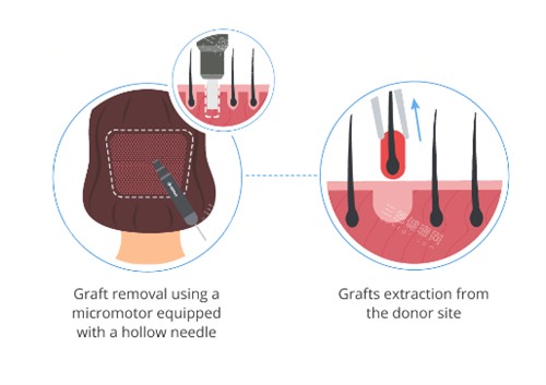 毛发移植过程图解