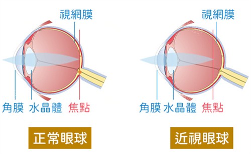 正常眼球和近视眼球的区别图解