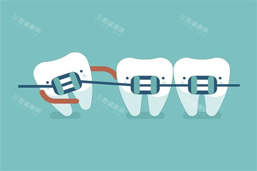 牙齿矫正卡通图