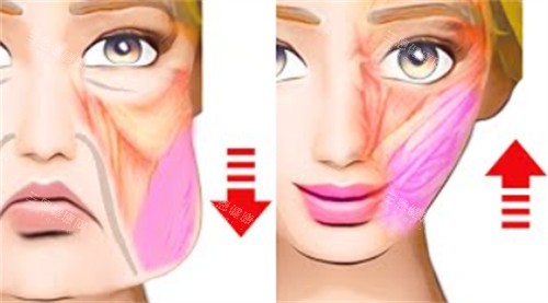 南京米兰柏羽面部提升改善皮肤和脂肪下垂及位移