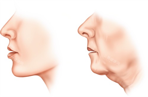 南京米兰柏羽面部提升前后皮肤对比