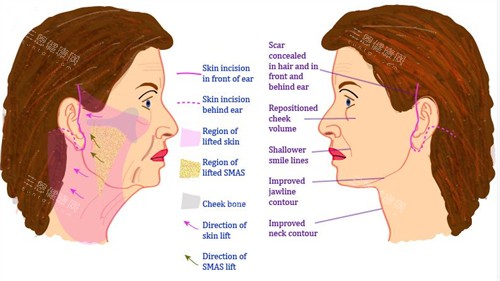 南京米兰柏羽面部提升手术对比图