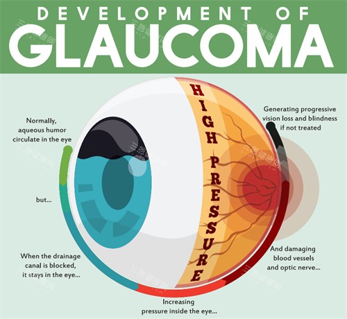 青光眼的眼睛结构图