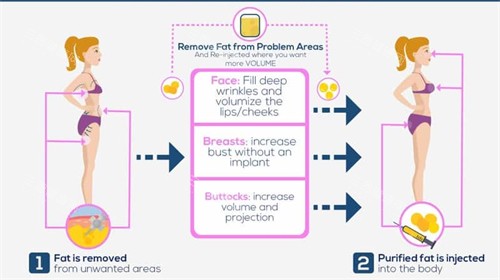 自体脂肪用来丰胸丰臀