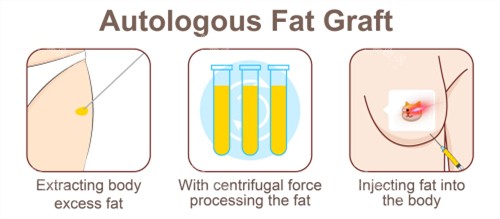 自体脂肪隆胸手术过程