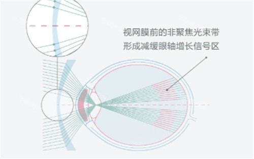 依视路星趣控镜片的作用图解