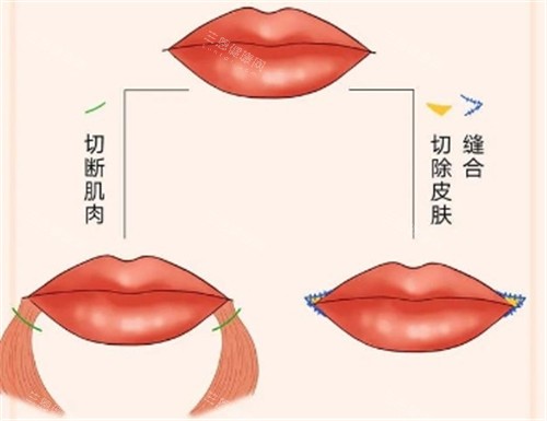 微笑唇整形动画示意图