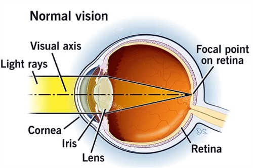 近视视光的样子图解