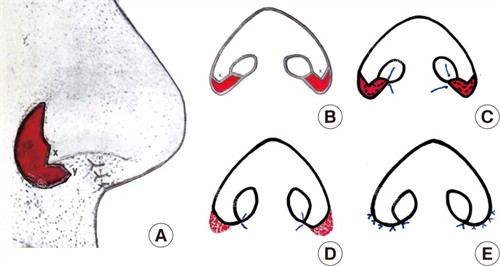 长春蓝天缩小鼻翼 长春蓝天缩小鼻翼