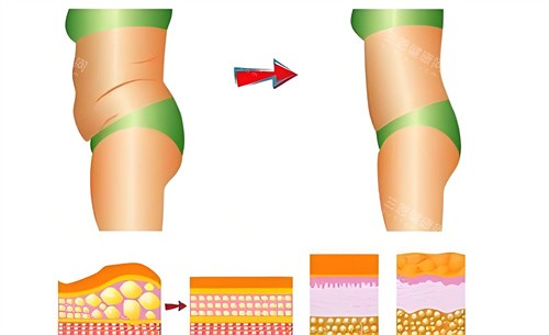 长春蓝天腰腹部吸脂术前后对比动画图 长春蓝天腰腹部吸脂术前后对比动画图