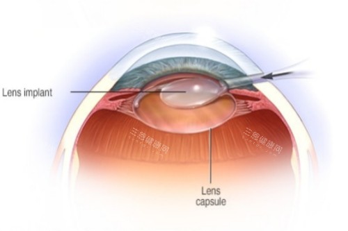 白内障晶体放入示意图