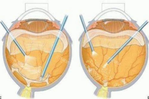 玻璃体切除术过程