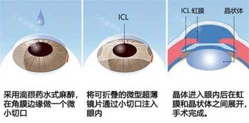 河源爱尔眼科近视手术价格:半飞秒/全飞秒/ICL晶体植入价格